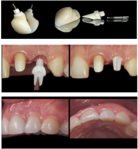 esthetique et implant dentaire